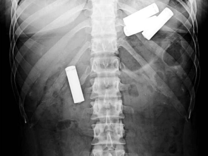 Самые жуткие предметы, которые когда-либо находили в человеческом желудке