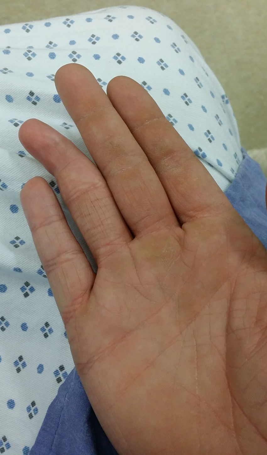 Сломанный палец