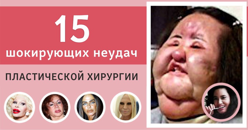 15 шокирующих неудач пластической хирургии