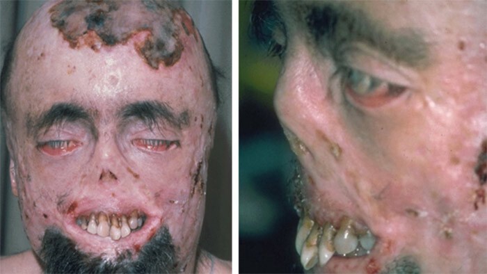 3. Синдром вампира (порфирия)