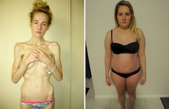 До и после: история анорексички