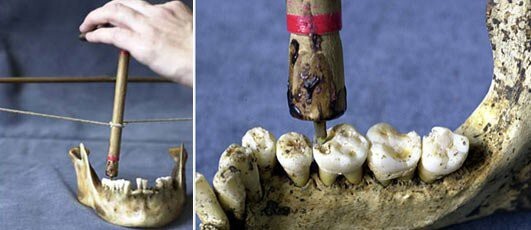 11. Самая древняя стоматология (9000 лет).