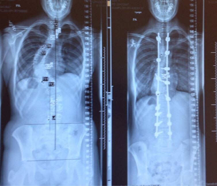 14. Рентгеновские снимки до и после исправления сколиоза 