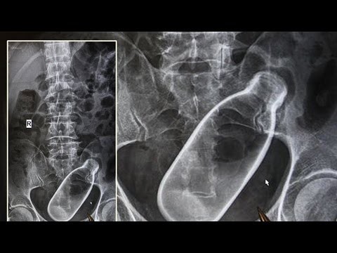10 самых шокирующих рентген снимков. Часть 2 