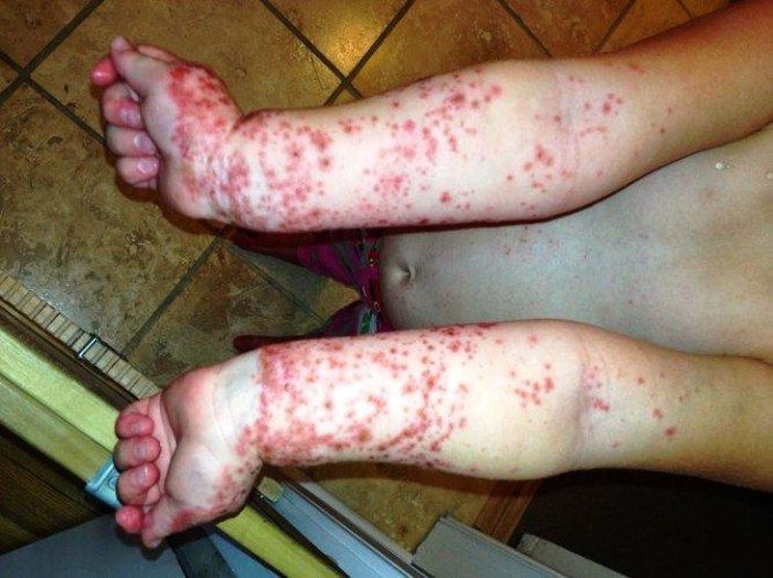 Вот ужасная история одной американки, чей 10-летний сын начал покрываться страшными красными волдырями из-за заражения, пока все думали, что это - симптомы аллергии или от укусов насекомых...