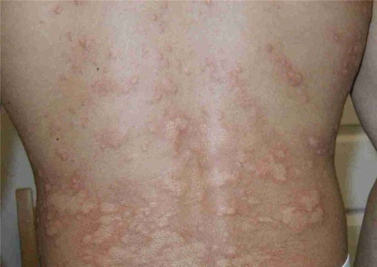 Aquagenic urticaria