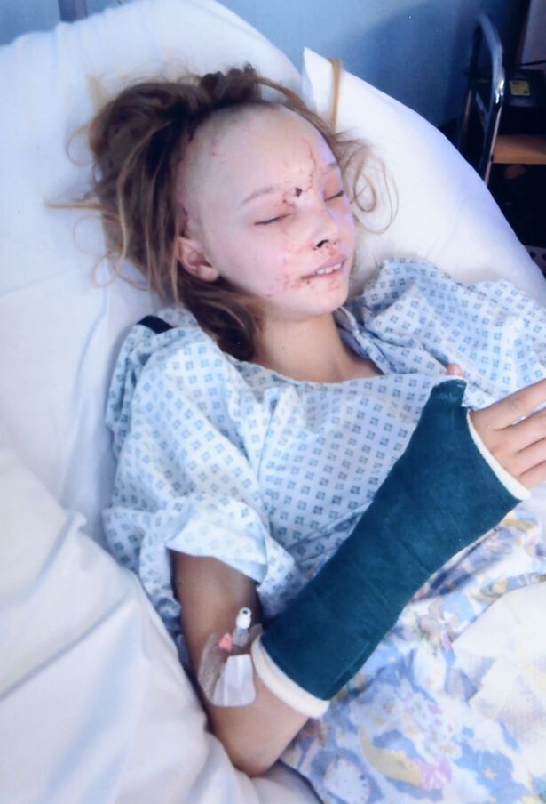 Хирургам потребовалось снять этой девочке лицо, чтобы восстановить разбитые в аварии кости черепа