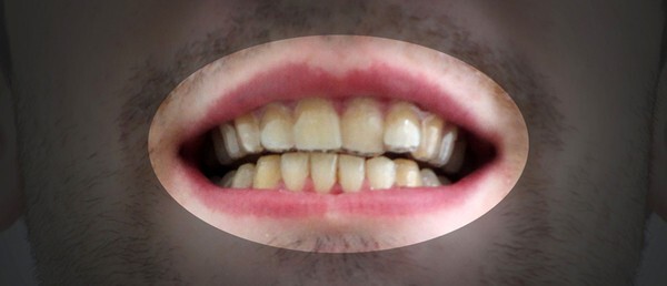 Сам себе стоматолог: американский студент исправил прикус при помощи 3D печати