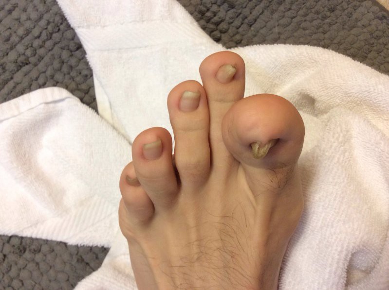 Лечение вросшего ногтя на большом пальце ноги
