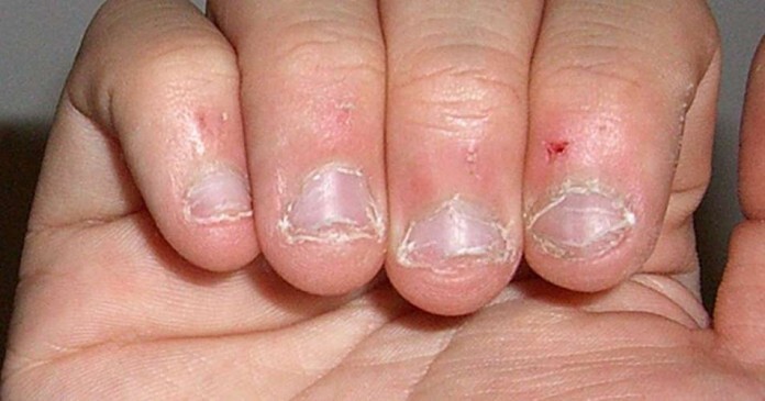 4) Привычка грызть ногти