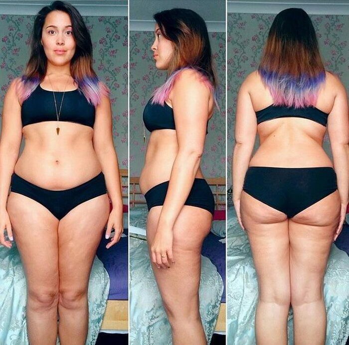 Девушка едва не умершая от анорексии набрала вес и публикует свои фото в бикини, чтобы помочь другим
