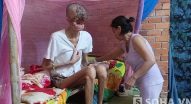 Плотоядная бактерия съела лицо вьетнамца 