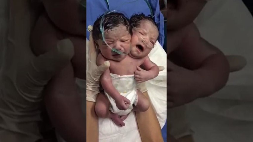 Cиамские близнецы родились в одном теле с двумя головами 