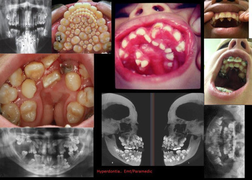 Полиодонтия — аномалия развития: избыточное количество зубов.
