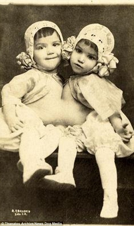 Гваделупа и Джозефина Инохоса были известны как Кубинские близняшки. Фотография сделана в 1914 году: «шоу уродов» в цирке процветали и в XX веке