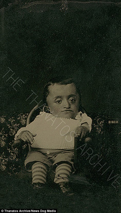 Ребенок с карликовостью, 1870-е годы