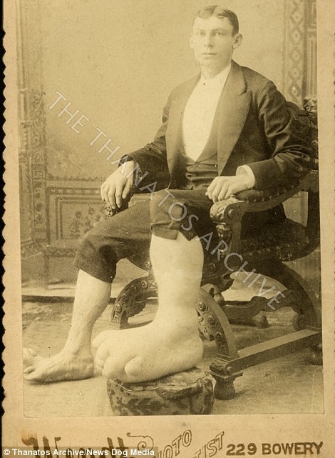 Мужчина с элефантиазом, 1890-е годы