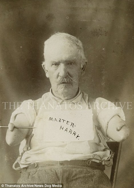 Мужчина родился с деформированными руками, 1900-е годы