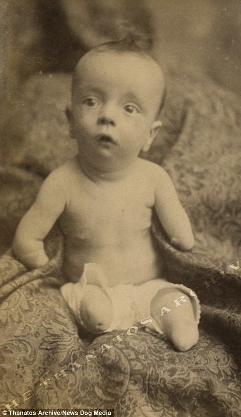 Чарльз Льюис родился без ног и рук в 1885 году