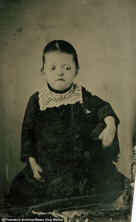 Очевидно, у девочки синдром Аперта. Фотография была сделана в 1870-х, однако болезнь впервые описали лишь в 1906 году