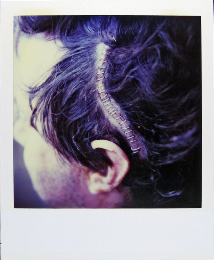4 мая 1997 года: шрам после операции