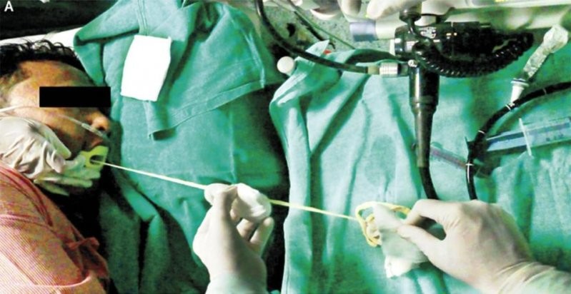 Индийские врачи извлекли двухметрового червя из кишечника мужчины