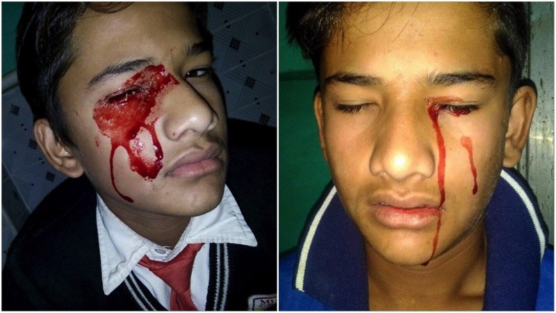  Из-за страшной болезни у индийского мальчика идёт кровь из глаз