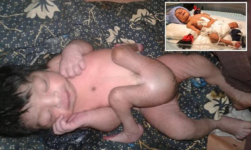  Шок: индийские врачи сделали операцию мальчику, родившемуся с четырьмя ногами!