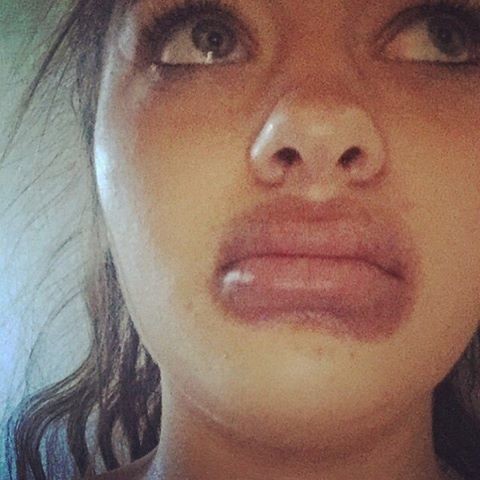 19-летняя ростовчанка попыталась увеличить губы пылесосом