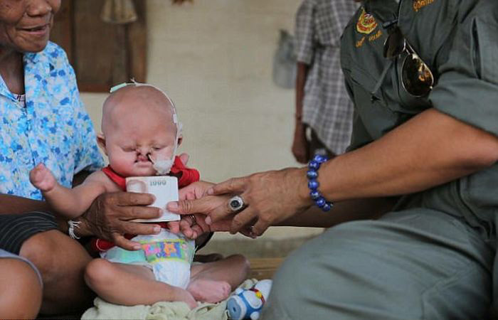 Бедный младенец с "синдромом русалки" из Таиланда