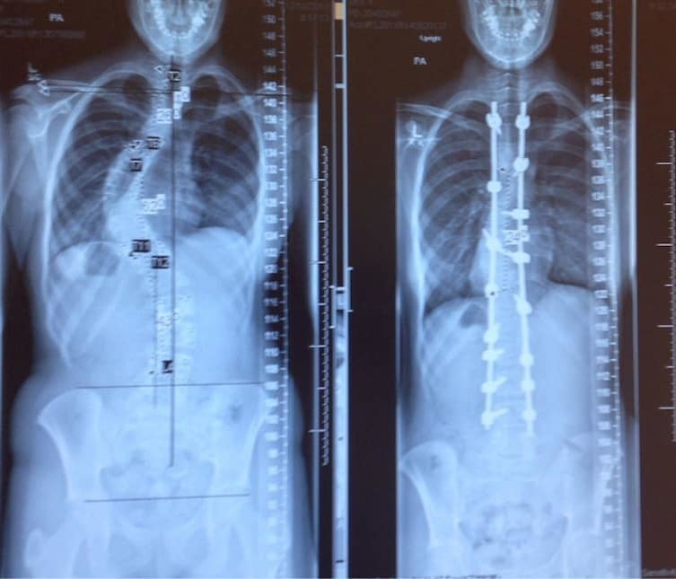 Рентгеновские снимки пациента до и после лечения сколиоза