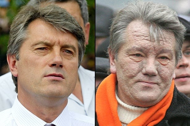 Виктор Ющенко, бывший президент Украины, до и после отравления диоксином