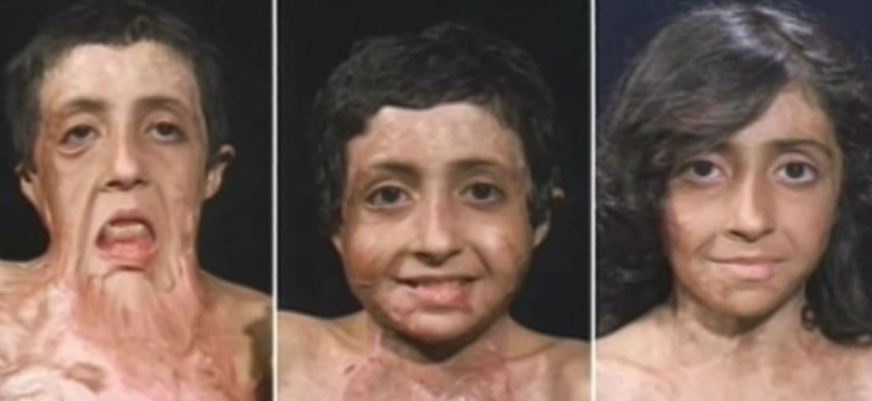 12 пластических операций вернули лицо афганской девочке, обгоревшей в пожаре
