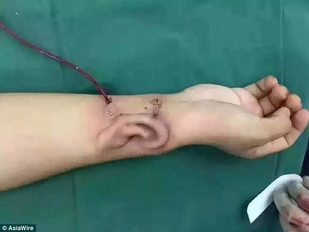 Китайские медики вырастили новое ухо для пострадавшего в аварии на его собственной руке