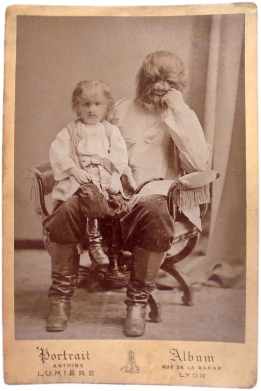 Больные гипертрихозом Адриан и Федор Евтихиевы, 1870-е.