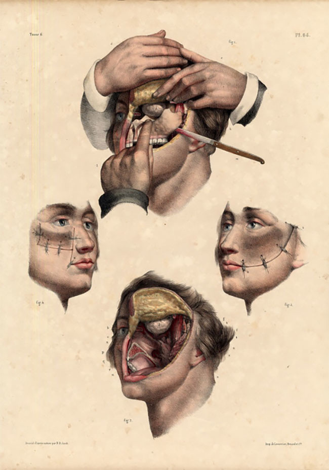 Шокирующие иллюстрации из руководства по хирургии XIX века