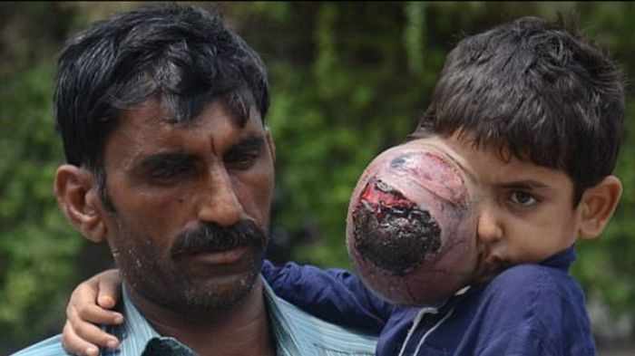 1 июня, Daily Mail опубликовали информацию о 7-летнем ребенке Али Хассане с огромной опухолью на глазу.