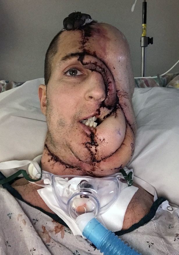Мужчину, потерявшего лицо из-за опухоли, спас гениальный хирург