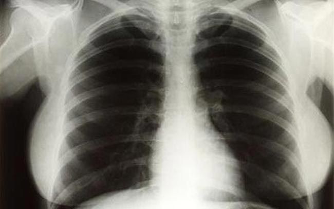 Рентген грудной клетки Мэрилин Монро