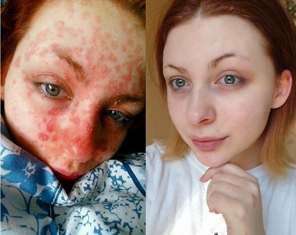 Бьюти-блогера, страдающую псориазом, бросил бойфренд, увидев ее без макияжа
