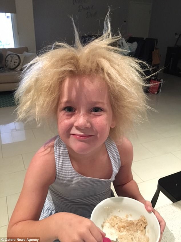 У 7-летней Шилы Калверт Инь из Мельбурна, Австралия, редкая врожденная аномалия - синдром нерасчесываемых волос
