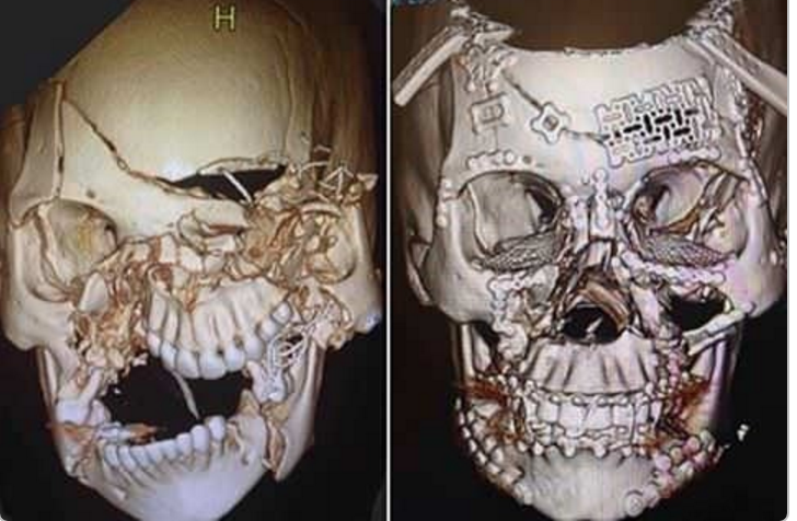 Хирург показал важность ремней безопасности, выложив рентген черепа после ДТП