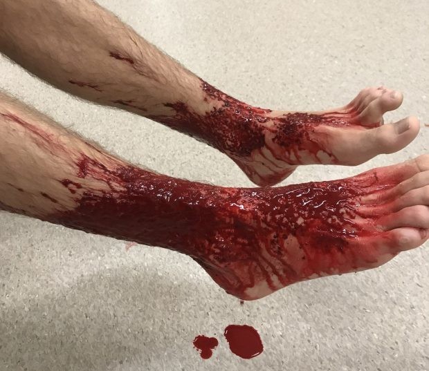 В Австралии странные крошечные морские вампиры атаковали ноги подростка