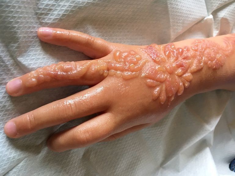 После временной тату в Египте вся рука семилетней девочки покрылась жуткими шрамами