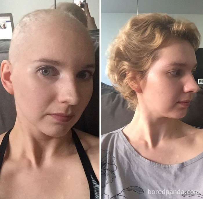 "Год назад у меня не было выбора - пришлось побриться налысо из-за химиотерапии. Теперь - я здорова! Правда, растут сумасшедшие завитушки"