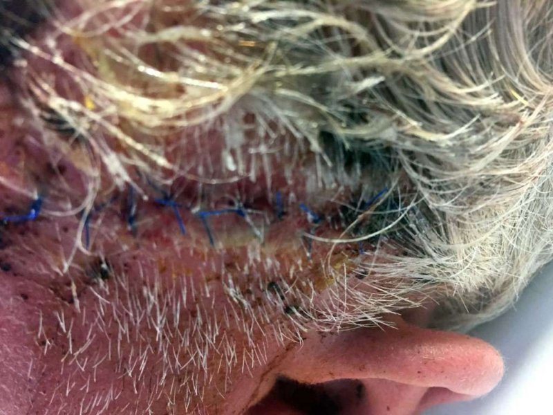 Фотографии мужчины после нападения гризли