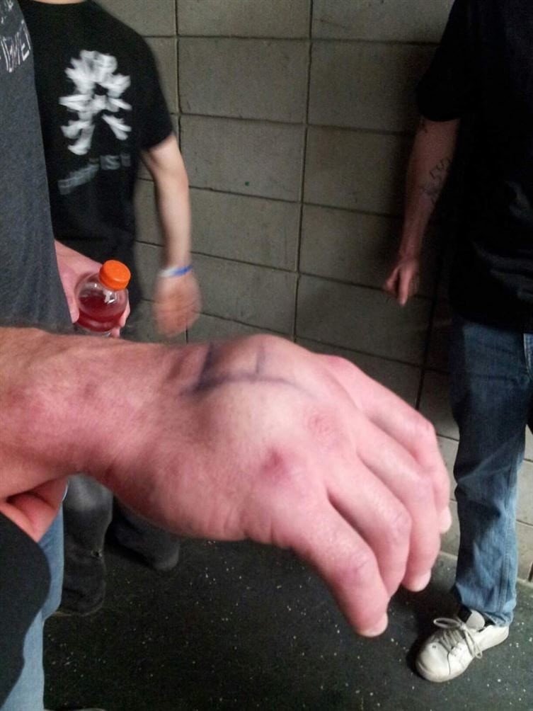 Рука боксера опухла после того, как он нанес нокаутирующий удар
