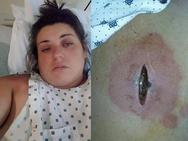 Женщина попала в реанимацию из-за укуса маленького паучка