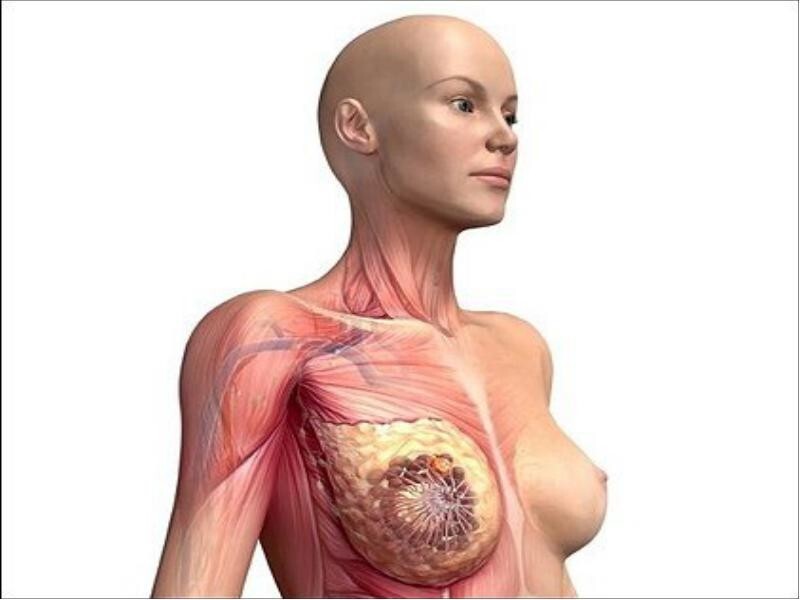  Рак груди