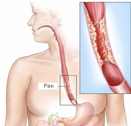  Рак пищевода